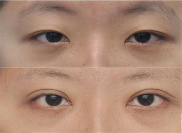 做個<a href=http://www.f3bb6.cn/listinfo-711-0.html target=_blank class=infotextkey>開眼角</a><a href=http://www.f3bb6.cn/listinfo-724-0.html target=_blank class=infotextkey>雙眼皮</a>多少錢