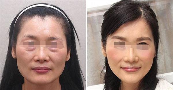 面部拉皮<a href=http://www.f3bb6.cn/listinfo-614-0.html target=_blank class=infotextkey>除皺</a>的5種方法