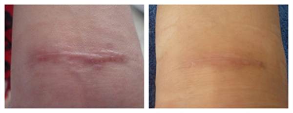 疤痕是先變硬后變軟嗎