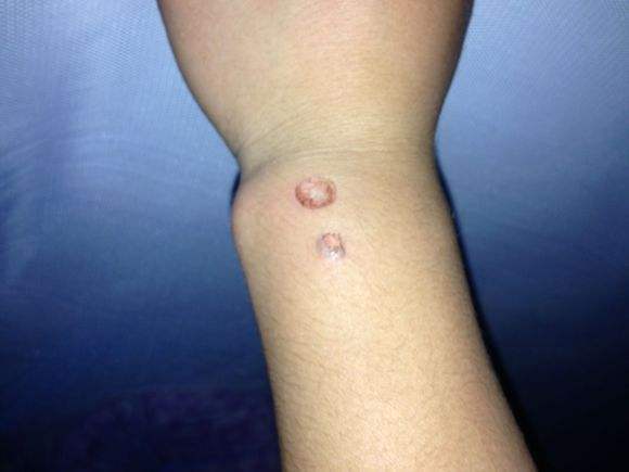 煙疤怎么去除多少錢