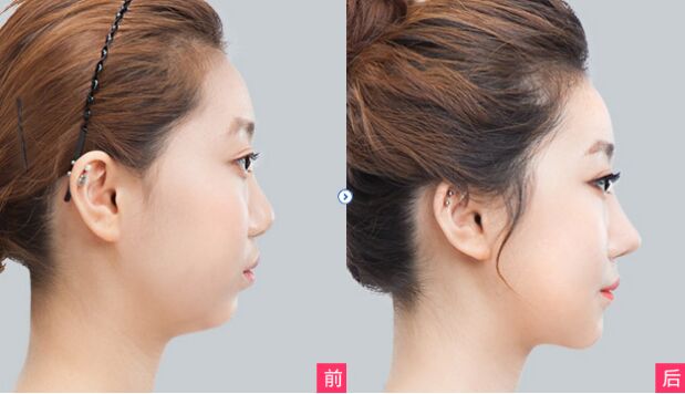 硅膠<a href=http://www.f3bb6.cn/listinfo-737-0.html target=_blank class=infotextkey>隆鼻</a>多久消腫