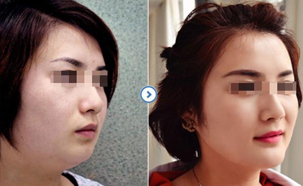 做一個(gè)下巴多少錢