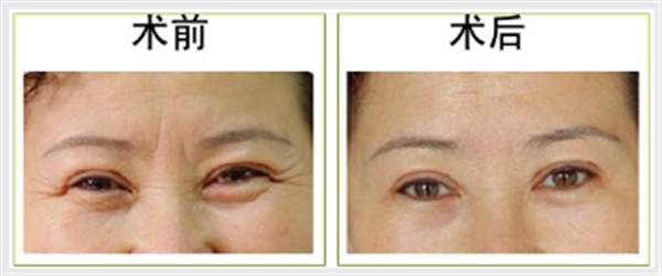 魚尾紋<a href=http://www.f3bb6.cn/listinfo-614-0.html target=_blank class=infotextkey>除皺</a>抗衰安全嗎