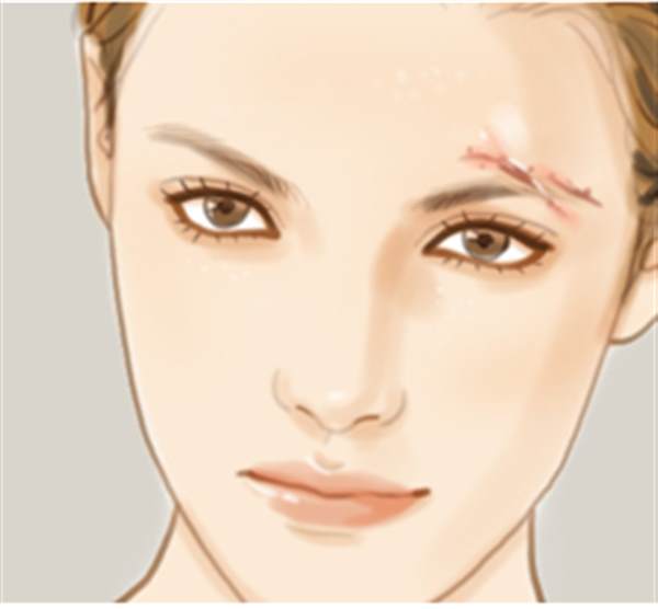 疤痕軟化針激素副作用有哪些