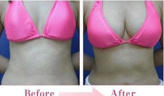 自體脂肪<a href=http://www.f3bb6.cn/listinfo-618-0.html target=_blank class=infotextkey>隆胸</a>的須知