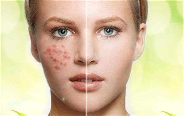 <a href=http://www.f3bb6.cn/listinfo-781-0.html target=_blank class=infotextkey>祛痘印</a>祛痘疤痘坑效果怎么樣