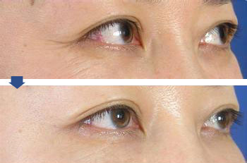 魚尾紋注射<a href=http://www.f3bb6.cn/listinfo-614-0.html target=_blank class=infotextkey>除皺</a>方法有哪些優(yōu)勢(shì)