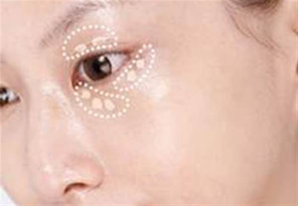 眼袋手術修復的四種方法