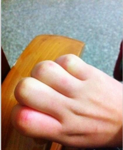 凍傷疤痕修復快的方法