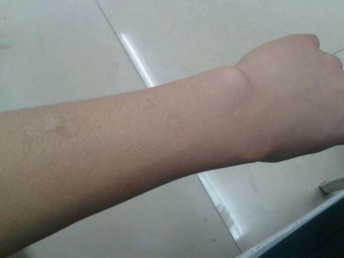 胳膊上的煙疤怎么去掉