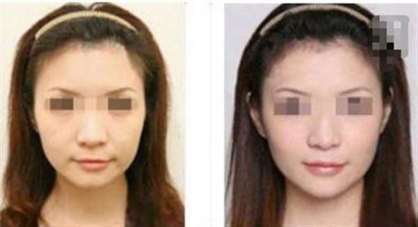 美容拉皮術多少錢