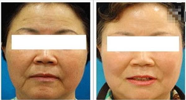 拉皮美容多少錢