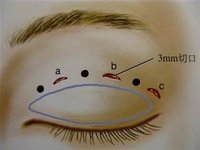 割<a href=http://www.f3bb6.cn/listinfo-724-0.html target=_blank class=infotextkey>雙眼皮</a>手術(shù)失敗怎么補救