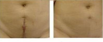 手術后的疤痕怎么修復