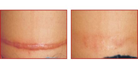 揭秘疤痕軟化針該怎么用