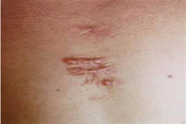 疤痕增生自己真的會消失嗎