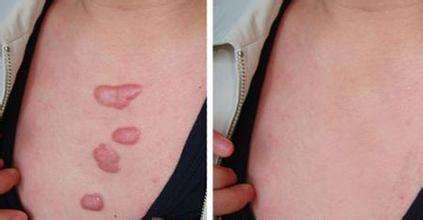 激光<a href=http://www.f3bb6.cn/listinfo-783-0.html target=_blank class=infotextkey>祛疤</a>大概需要多少錢