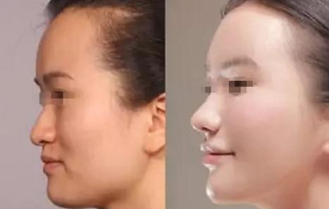 成都膨體<a href=http://www.f3bb6.cn/listinfo-737-0.html target=_blank class=infotextkey>隆鼻</a>手術后注意事項有哪些