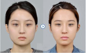 做<a href=http://www.f3bb6.cn/listinfo-629-0.html target=_blank class=infotextkey>下頜角</a>手術(shù)費用