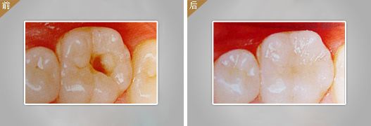 補(bǔ)一顆大牙要多少錢