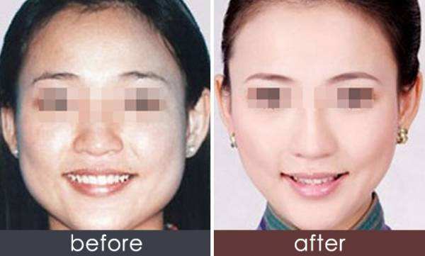 打<a href=http://www.f3bb6.cn/listinfo-631-0.html target=_blank class=infotextkey>瘦臉</a><a href=http://www.f3bb6.cn/listinfo-614-0.html target=_blank class=infotextkey>除皺</a>多久可以吃飯