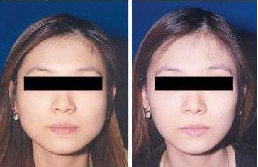 打<a href=http://www.f3bb6.cn/listinfo-631-0.html target=_blank class=infotextkey>瘦臉</a><a href=http://www.f3bb6.cn/listinfo-614-0.html target=_blank class=infotextkey>除皺</a>會皮膚松弛嗎