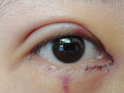 疤痕增生的治療方法是什么