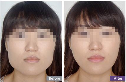 打完<a href=http://www.f3bb6.cn/listinfo-631-0.html target=_blank class=infotextkey>瘦臉</a><a href=http://www.f3bb6.cn/listinfo-614-0.html target=_blank class=infotextkey>除皺</a>多久能吃辣