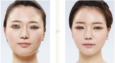 <a href=http://www.f3bb6.cn/listinfo-631-0.html target=_blank class=infotextkey>瘦臉</a><a href=http://www.f3bb6.cn/listinfo-614-0.html target=_blank class=infotextkey>除皺</a>打完多久見效