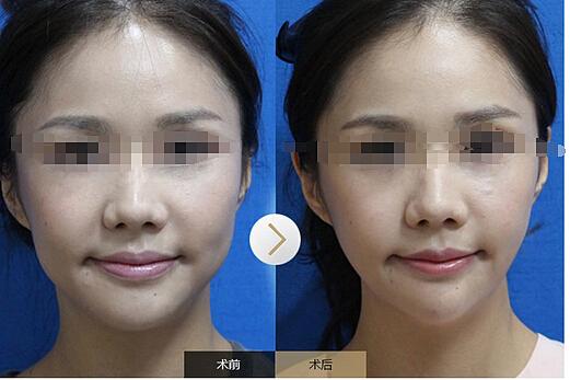 打完<a href=http://www.f3bb6.cn/listinfo-631-0.html target=_blank class=infotextkey>瘦臉</a><a href=http://www.f3bb6.cn/listinfo-614-0.html target=_blank class=infotextkey>除皺</a>影響懷孕嗎