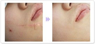 注射<a href=http://www.f3bb6.cn/listinfo-783-0.html target=_blank class=infotextkey>祛疤</a>可能會引起皮膚并發癥