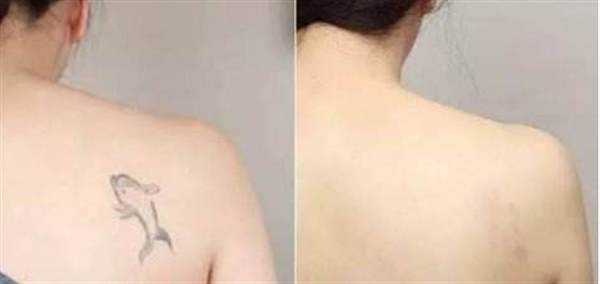 疤痕性皮膚一般可以紋身嗎