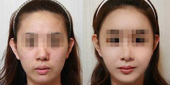 脂肪填充脂肪會(huì)移位嗎