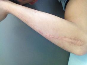 常見的疤痕修復手術的種類