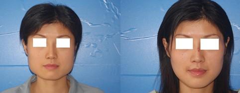 成都<a href=http://www.f3bb6.cn/listinfo-629-0.html target=_blank class=infotextkey>下頜角</a>整形的手術方式有哪些