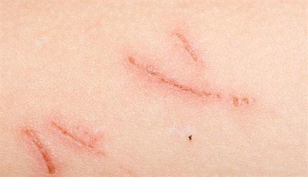 切掉疤痕還會有痕跡嗎