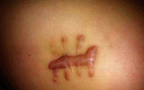 生活中常見的疤痕分成哪幾種類型