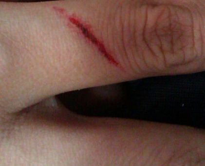 手上有疤痕該如何修復呢