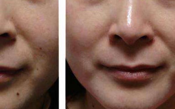 懷孕點痣有什么影響