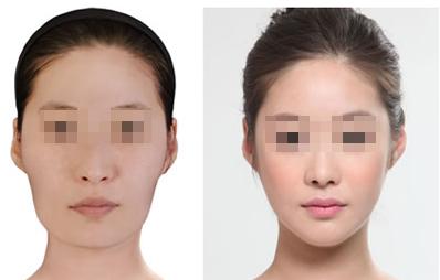 長春注射保妥適<a href=http://www.f3bb6.cn/listinfo-614-0.html target=_blank class=infotextkey>除皺</a>瘦型素<a href=http://www.f3bb6.cn/listinfo-631-0.html target=_blank class=infotextkey>瘦臉</a>需要多少錢