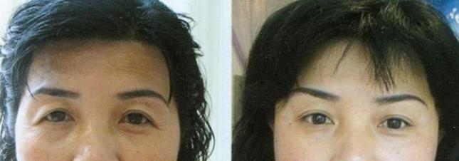 北京韓式提眉手術有什么特點