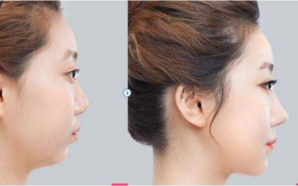 福州<a href=http://www.f3bb6.cn/listinfo-737-0.html target=_blank class=infotextkey>隆鼻</a>價格