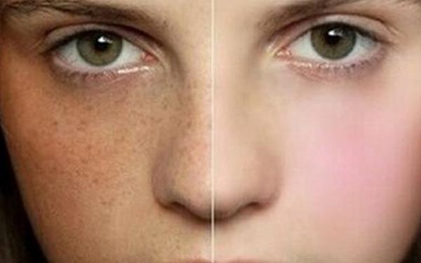 做激光祛黃褐斑手術多少錢