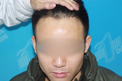 北京頭發種植的價格