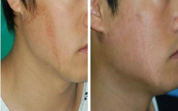 如何去除10幾年的疤痕