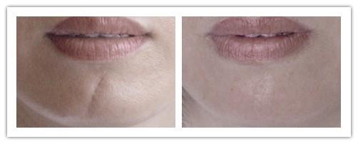 面部縫針疤痕修復