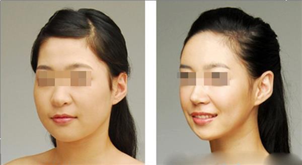 <a href=http://www.f3bb6.cn/listinfo-631-0.html target=_blank class=infotextkey>瘦臉</a><a href=http://www.f3bb6.cn/listinfo-614-0.html target=_blank class=infotextkey>除皺</a>為什么可以<a href=http://www.f3bb6.cn/listinfo-631-0.html target=_blank class=infotextkey>瘦臉</a>