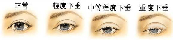 上臉下垂矯正的效果怎么樣？