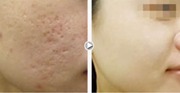 臉上的凹陷疤多久恢復(fù)