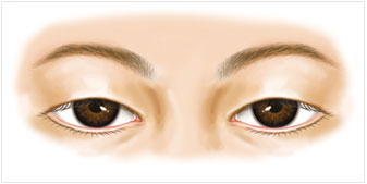 上瞼下垂的術后護理事項